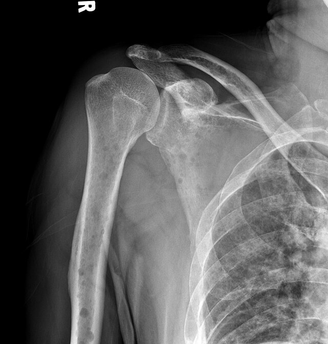 multiple myeloma involving the humerus