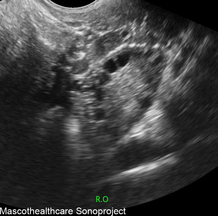 polycystic ovary on scan