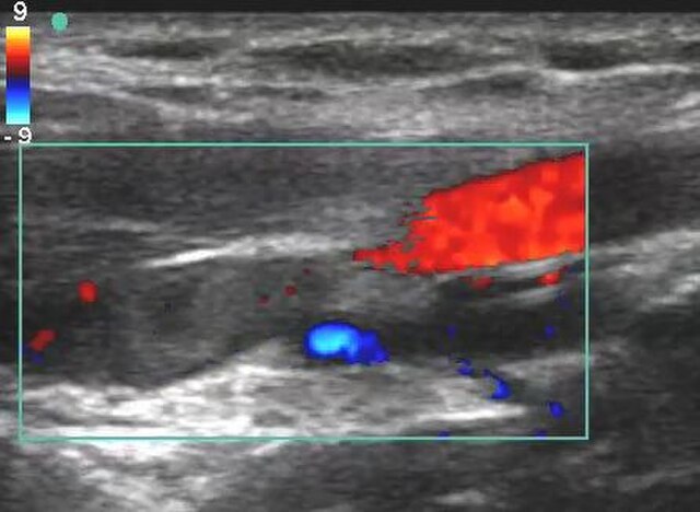 venous doppler