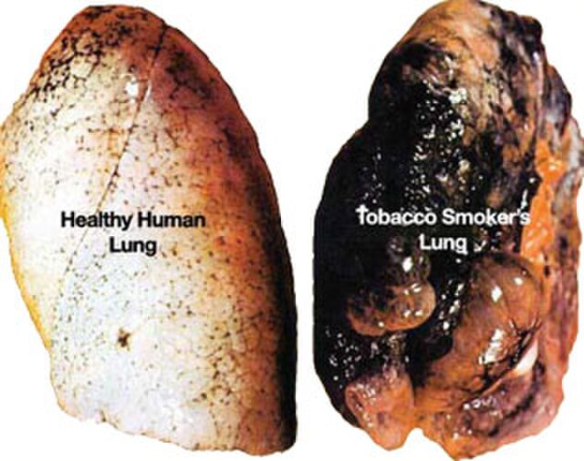 smoker lung