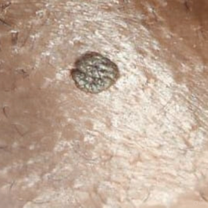 solitary genital wart