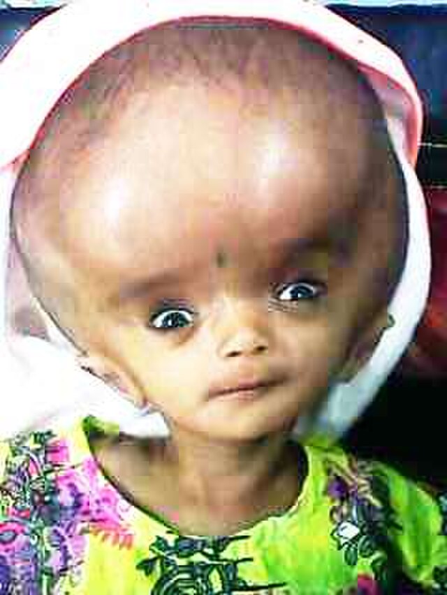 How to Prevent Hydrocephalus – A Guide for Women in Lagos Planning Pregnancy