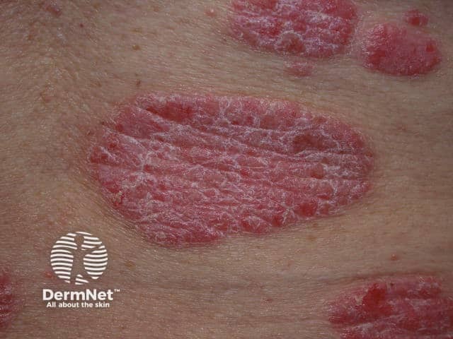 chronic plaque psoriasis
