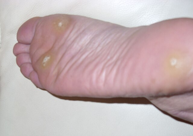 Understanding Plantar Warts: What You Should Know in Lagos