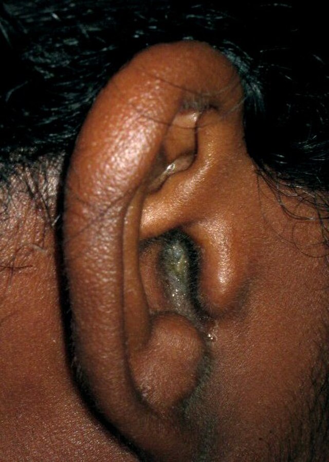 Itchy, Painful Ears? It Could Be Otitis Externa