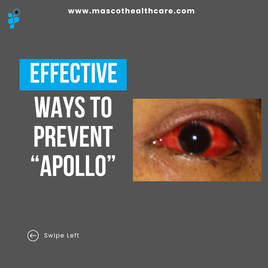 How to Prevent Catching “Apollo” (Conjunctivitis)