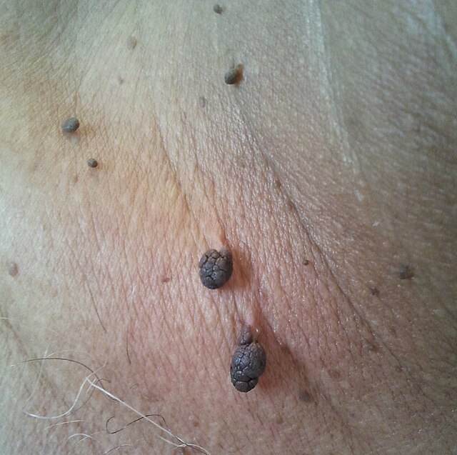 What Looks Like Genital Warts… But Isn’t?