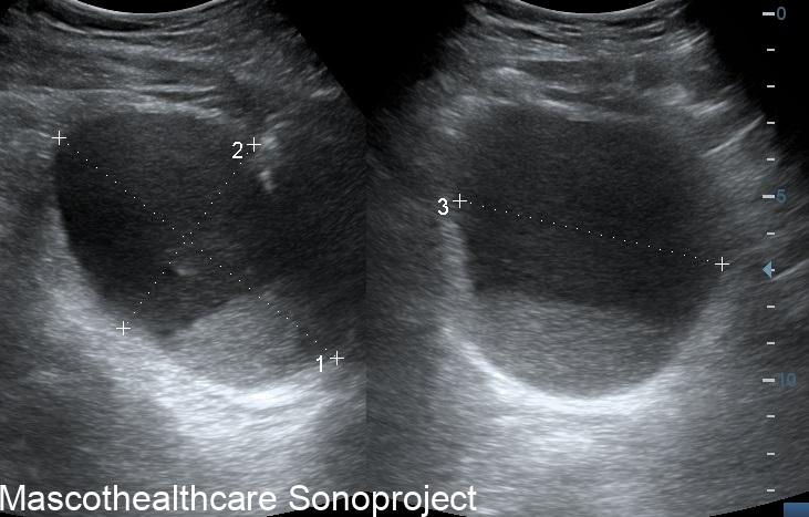 Urinary Bladder Sludge – Mascot Healthcare Sonoproject