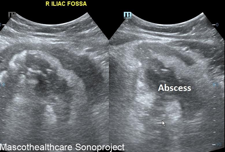 Appendiceal abscess – Mascot Healthcare Sonoproject