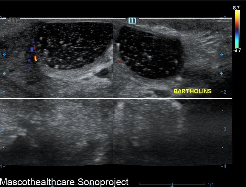 Bartholinitis Bartholin’s Gland Cyst(and Skenes) – Mascot Healthcare Sonoproject
