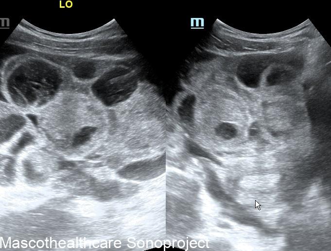Ultrasound Features of Ovarian Hyperstimulation Syndrome – Mascot ...