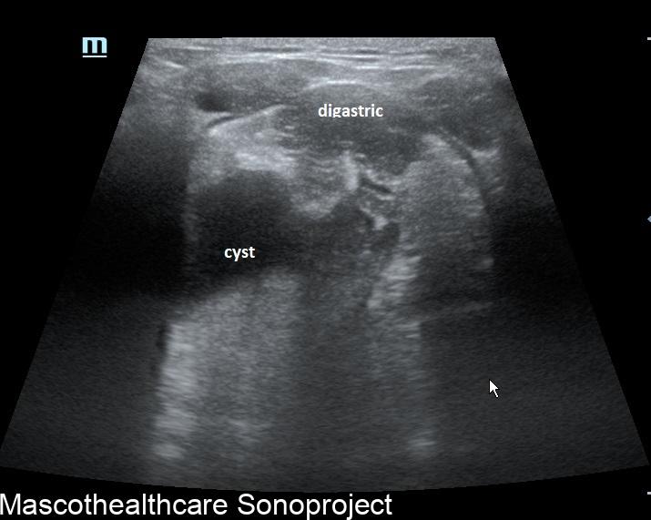 Ranula Ultrasound