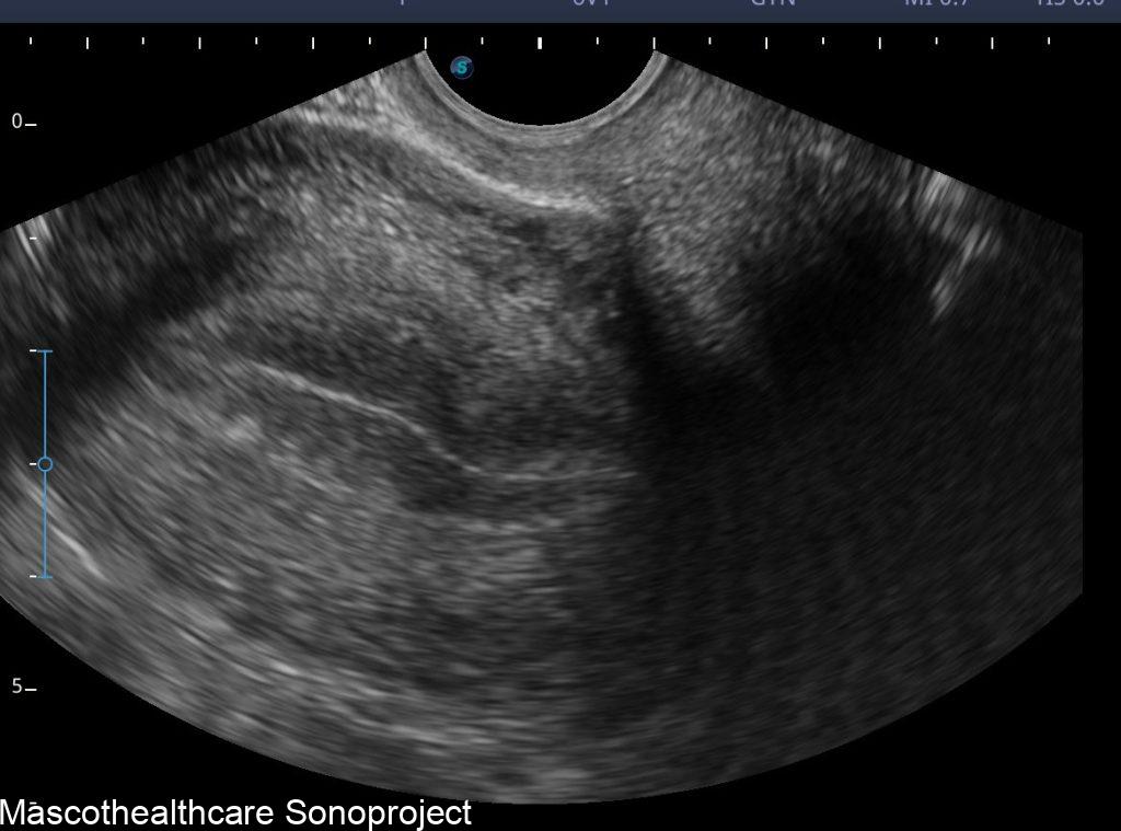 Normal Uterus – Mascot Healthcare Sonoproject