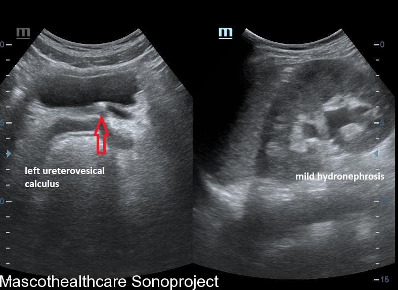 Hydroureter secondary to obstructing vesical calculus – Mascot ...